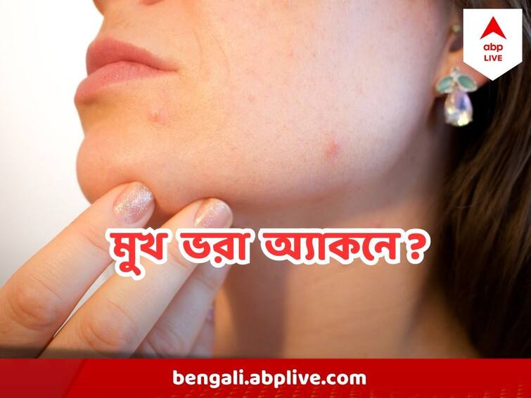 Solve Summer Acne Problem With these daily Habits Summer Acne Problem : গরমে ব্রন নিয়ে জেরবার ? এই নিয়মগুলি মেনে চললে মিলবে মুক্তি