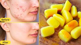 Skin care: સ્કિનની આ સમસ્યાને જડમૂળથી દૂર કરશે હળદર આઈસ ક્યૂબ, જાણો ઉપયોગ કરવાની સાચી રીત