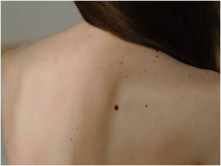 Not only moles but these symptoms are also signs of skin cancer Skin Cancer: పుట్టుమచ్చలే కాదు ఈ లక్షణాలు కూడా చర్మ క్యాన్సర్ సంకేతాలే