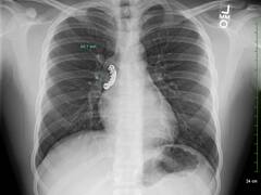 अमेरिका में लड़के को आयी मिर्गी, फिर हुआ कुछ ऐसा कि लगाने पड़े हॉस्पिटल के चक्कर