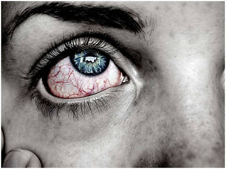These are the symptoms seen in the eye if BP is increased High BP: బీపీ పెరిగితే కంటిలో కనిపించే లక్షణాలు ఇవే