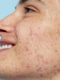 स्किन पर काले धब्बे हो सकते हैं इस बीमारी के शुरुआती लक्षण