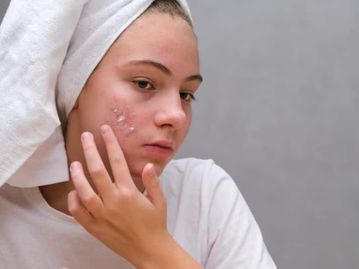 Toothpaste should be applied on pimples or not know from skin expert क्या चेहरे पर टूथपेस्ट लगाने से पिंपल्स ठीक हो सकते हैं? जानिए इस बारे में क्या कहते हैं एक्सपर्ट