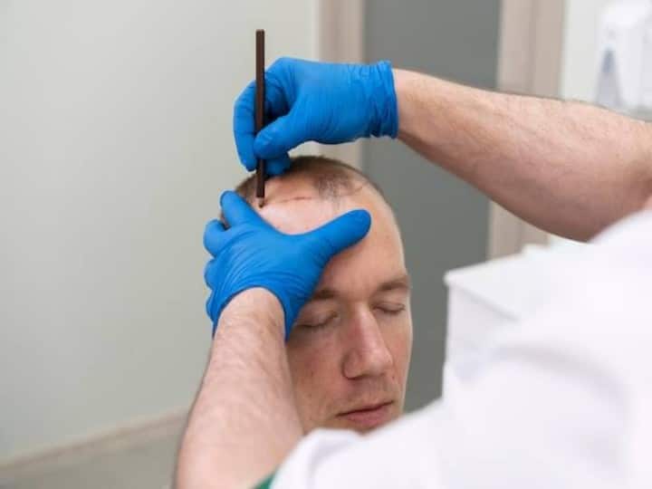 Hair Transplant: How long does hair last after hair transplant?  how much money is spent