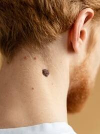 अनचाहे मस्सों को घर पर ही दूर करने का आसान उपाय