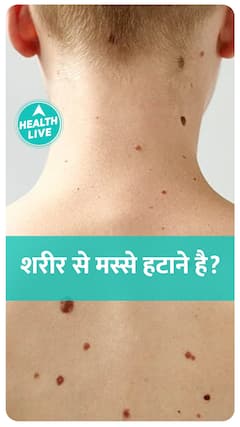 शरीर से मस्से कैसे गायब करें?