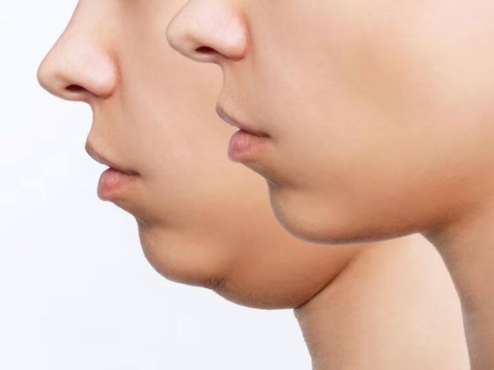 How To Reduce Face Fat Tips To Slim Down Your Double Chin 'डबल चिन' से हैं परेशान? इन 5 टिप्स से पाएं फेस के एक्स्ट्रा फैट से छुटकारा