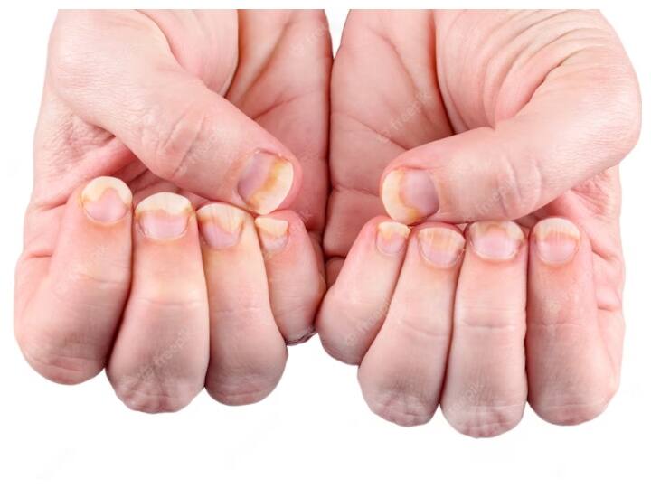 Yellow Nail Syndrome: पीले नाखून की दिक्कत कहीं अंदरुनी बीमारियों का संकेत तो नहीं... जानिए क्या है इसकी वजह