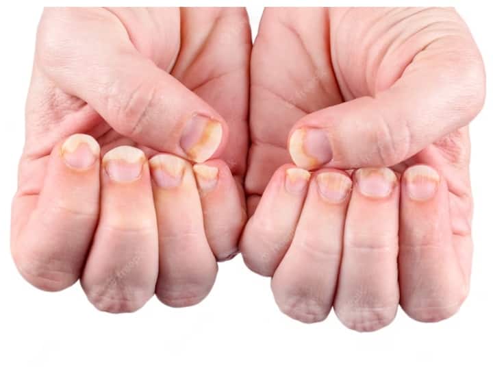 Health tips reason behind yellow nail syndrome it can result in severe health problem Yellow Nail Syndrome: पीले नाखून की दिक्कत कहीं अंदरुनी बीमारियों का संकेत तो नहीं... जानिए क्या है इसकी वजह