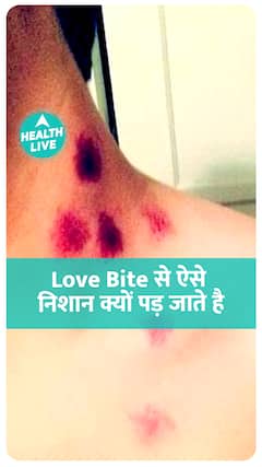 Love Bite के निशान क्यों पढ़ जाते है ?