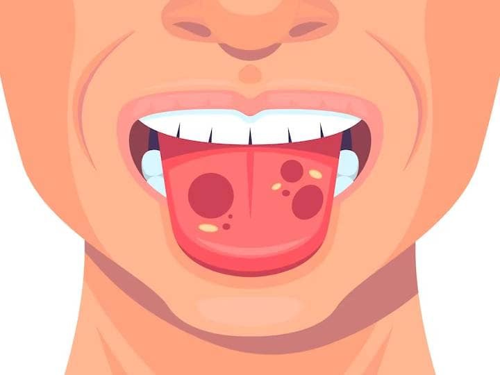 Is It Mouth Ulcer Or Oral Cancer Here's How To Identify It मुंह में होने वाले छाले अल्सर है या कैंसर? दोनों के बीच के अंतर को ऐसे पहचानें