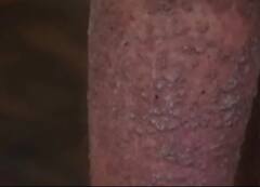 मगरमच्छ के जैसी त्वचा वाला आदमी, देखें कैसे बदल रही है इस शख्स की स्किन