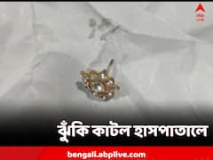 শ্বাসনালিতে আটকে কানের দুল! সরকারি হাসপাতালে অস্ত্রোপচার ছাড়াই সুস্থ শিশু
