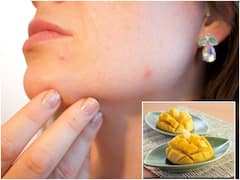 మామిడి పండ్లు తినగానే మొటిమలు ఎందుకు వస్తాయో తెలుసా?