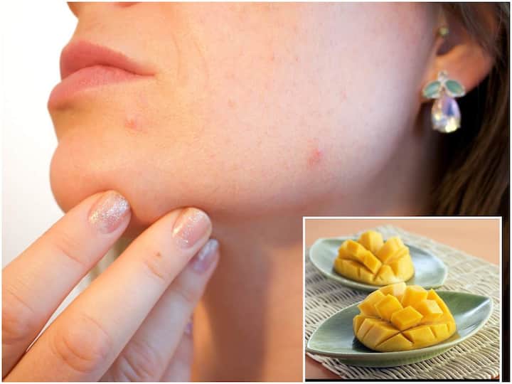 Do You Know Why You Get Pimples After Eating Mango Pimples: మామిడి పండ్లు తినగానే మొటిమలు ఎందుకు వస్తాయో తెలుసా?