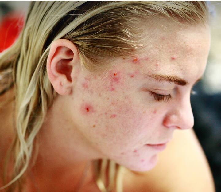 মুখের উপরিভাগে কোনও জ্বালাপোড়ার অনুভূতি থাকলেও দুরন্ত কাজে দিতে পারে বরফগলা জল।