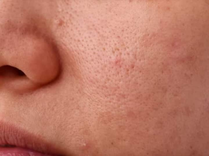 Skin Care Tips : चेहऱ्यावरील खुल्या छिद्रांपासून मुक्त होण्यासाठी, काही प्रभावी उपाय करणे खूप महत्वाचे आहेत, कारण जर तुम्ही असं केलं नाही तर यामुळे त्वचा आणखी खराब होऊ शकते.