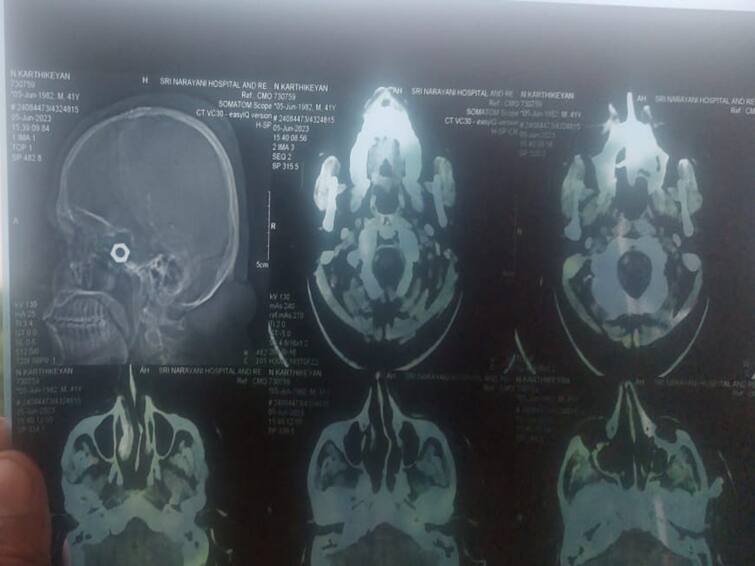 Vellore: Lorry driver admitted to government hospital after accident  due to a needle being placed inside head Crime: விபத்தால் அரசு மருத்துவமனையில் அனுமதி.. லாரி ஓட்டுநர் தலைக்குள் இருந்த மர்மபொருள்..! சிகிச்சையால் நடந்த தவறு!