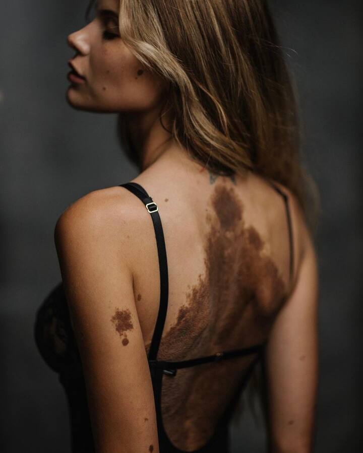 युलियाना युसेफ एक इंस्टाग्राम इन्फ्लुएंसर हैं. उनके शरीर पर बहुत बड़े-बड़े और कई सारे बर्थमार्क्स हैं. उनकी यह स्थिति जन्मजात है. जानकारी के मुताबिक, युलियाना के शरीर पर 2000 से ज्यादा बर्थमार्क्स हैं. बर्थमार्क्स की वजह से बचपन में उन्हें कई लोगों का मजाक सहन करना पड़ा था.