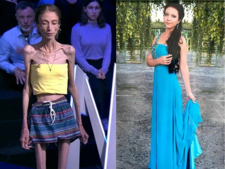 पति का टॉर्चर! पत्नी का घटवाया 17 किलो वजन, छुड़वा दी नौकरी, 'कंकाल' तक बना डाला, फिर छोड़ गया साथ Russia woman lose 17kg weight after husband demand now struggled with body thinness पति का टॉर्चर! पत्नी का घटवाया 17 किलो वजन, छुड़वा दी नौकरी, 'कंकाल' तक बना डाला, फिर छोड़ गया साथ