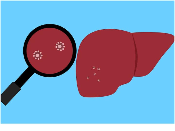 Early Symptoms Of Fatty Liver Disease Fatty Liver Disease: ఆకలిగా ఉండటం లేదా? ప్రమాదకరమైన వ్యాధికి ఇది ముందస్తు లక్షణం