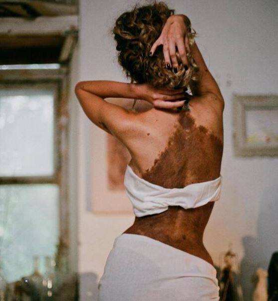 ਕਈ ਲੋਕ ਅਜਿਹੇ ਵੀ ਹਨ ,ਜਿਨ੍ਹਾਂ ਨੂੰ ਇਸ ਦੀ ਵਜ੍ਹਾ ਕਰਕੇ ਮਜ਼ਾਕ ਅਤੇ ਨਫ਼ਰਤ ਦਾ ਸਾਹਮਣਾ ਵੀ ਕਰਨਾ ਪੈਂਦਾ ਹੈ। ਅਜਿਹਾ ਹੀ ਕੁਝ ਪੋਲੈਂਡ ਦੀ ਰਾਜਧਾਨੀ ਵਾਰਸਾ ਦੀ ਰਹਿਣ ਵਾਲੀ ਯੂਲੀਆਨਾ ਯੂਸੇਫ ਨਾਲ ਵੀ ਹੋਇਆ ਹੈ।