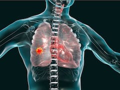 A New Study Reveals Lung Cancer Pill That Reduces Death Risk By Half. See What Experts Have To Say