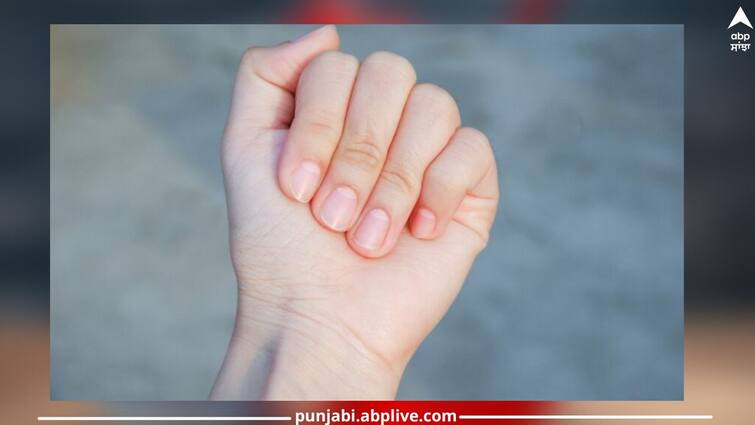 White Mark On Nails: Signs of diseases that cause white marks on nails White Mark On Nails: ਨਹੁੰਆਂ 'ਤੇ ਚਿੱਟੇ ਧੱਬੇ ਦਿੰਦੇ ਬਿਮਾਰੀਆਂ ਦਾ ਸੰਕੇਤ, ਨਜ਼ਰਅੰਦਾਜ਼ ਕਰਨਾ ਪੈ ਸਕਦਾ ਮਹਿੰਗਾ