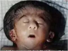 Viral: నాలుగు చేతులు, నాలుగు కాళ్లు, రెండు గుండెలతో జన్మించిన శిశువు, ఇలా పుట్టుకతోనే లోపాలు ఎందుకు వస్తాయి?