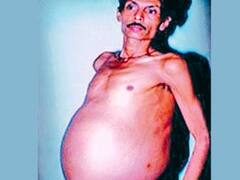 36 साल तक प्रेग्नेंट रहा ये शख्स, फूले पेट को समझता रहा ट्यूमर, मगर निकले 'जुड़वा बच्चे'!