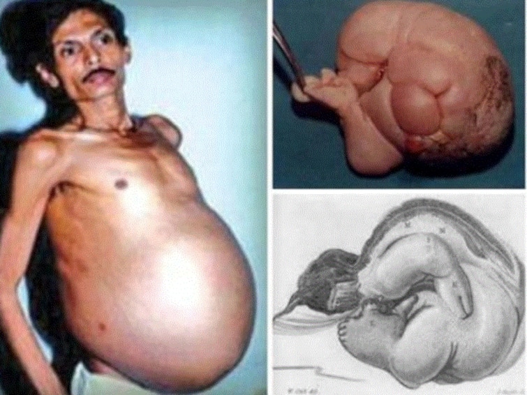 This Nagpur Man Was 'Pregnant' For 36 Years With Twins This Nagpur Man Was 'Pregnant' For 36 Years With Twins