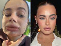 फ्री में मिला था 'लिप फिलर' का ऑफर, तो महिला ने करा लिया, अब होंठों का हो गया ये हाल