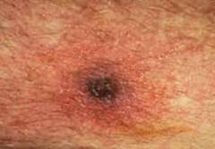 Scrub Typhus : বর্ষা শুরুতেই স্ক্রাব টাইফাসের হানা, কী দেখে বুঝবেন মাকড়ের কামড় ?