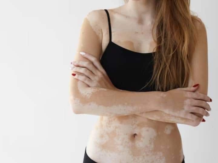 What is vitiligo and how does it affect your skin World Vitiligo Day: विटिलिगो या सफेद दाग होने से पहले शरीर देती है ये छोटे-छोटे संकेत, वक्त रहते इसकी पहचान करें