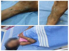 விளையாடி கொண்டிருந்த 12 வயது சிறுமி.. மின்வாரியத்தின் அலட்சியத்தால் மின் கம்பி அறுந்து விழுந்து விபத்து!