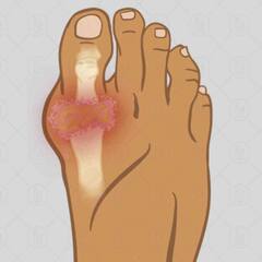 ਯੂਰਿਕ ਐਸਿਡ ਨੂੰ ਸਰੀਰ 'ਚੋਂ ਬਾਹਰ ਕੱਢਣ ਦਾ ਕੰਮ ਕਰਦੇ ਦੇ ਇਹ Fruits