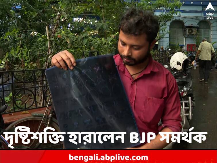 Purba Medinipur Patashpur BJP supporter loses vision in the right eye after alleged attack Patashpur News: চোখের বদলা চোখ নয়, শান্তিতে হোক ভোট, দৃষ্টিশক্তি হারিয়ে বার্তা বিজেপি সমর্থকের