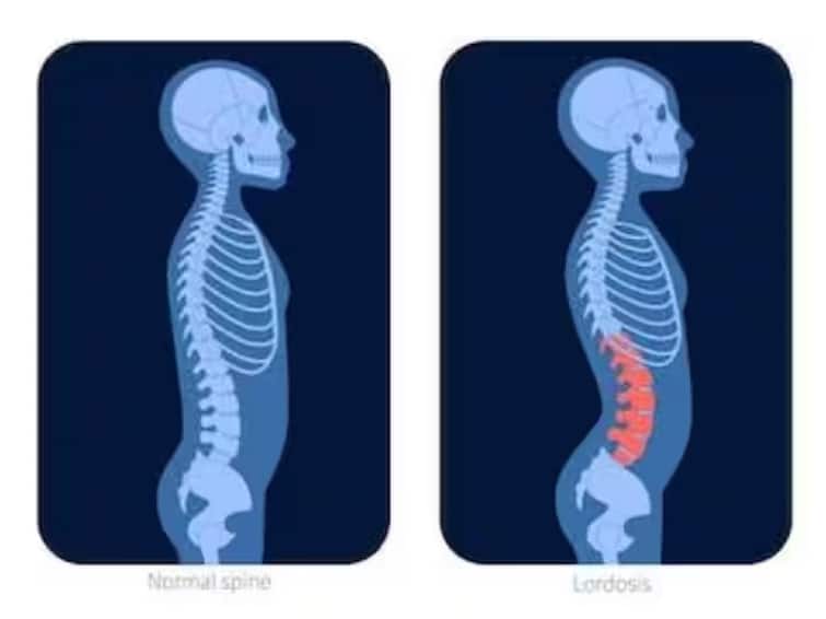 Spinal Stroke Symptoms know Causes Symptoms and treatment Health Tips Spinal Stroke Symptoms: झपाट्यानं वाढतायत स्पायनल स्ट्रोकची प्रकरणं; वेळीच लक्षणं ओळखा, नाहीतर...