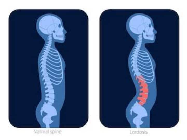 Cases of spinal stroke are increasing rapidly, know how to detect it in advance?