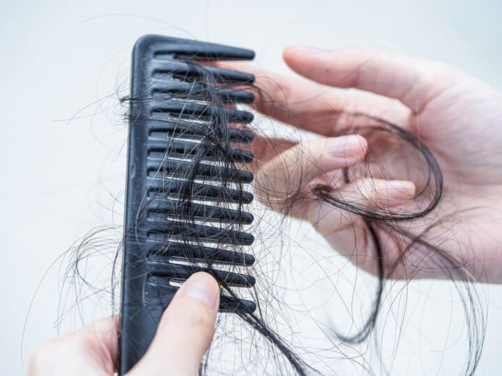 what is alopecia areata its cause symptoms क्या आपके भी बाल गुच्छों में झड़ रहे हैं? बारिश नहीं, कहीं ये एलोपेसिया की वजह से तो नहीं है?