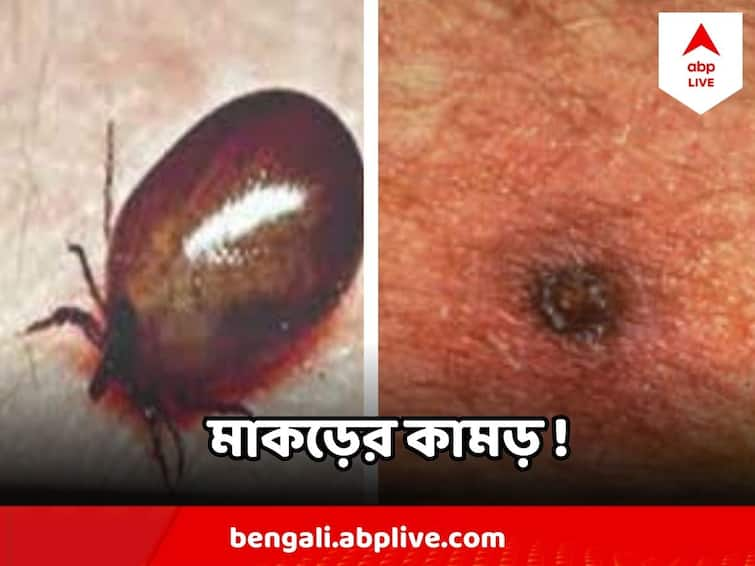 Scrub Typhus May Cause Death If Not Treated Timely, Know its Symptoms Scrub Typhus : মাকড়ের কামড় ! সময় থাকতে চিকিৎসা না হলেই প্রাণঘাতী হতে পারে স্ক্রাব টাইফাস