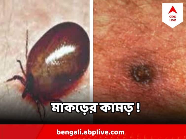 Scrub Typhus : মাকড়ের কামড় ! সময় থাকতে চিকিৎসা না হলেই প্রাণঘাতী হতে পারে স্ক্রাব টাইফাস Scrub Typhus May Cause Death If Not Treated Timely, Know its Symptoms Scrub Typhus : মাকড়ের কামড় ! সময় থাকতে চিকিৎসা না হলেই প্রাণঘাতী হতে পারে স্ক্রাব টাইফাস