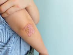 एक्जिमा और सोरायसिस जैसी स्किन प्रॉब्लम से जूझ रहे हैं तो इन Foods से बना लें दूरी, वर्ना बढ़ सकती है समस्या