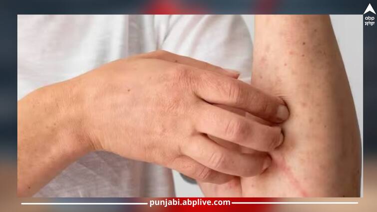 tinea-versicolor-is-a-common-fungal-infection-in-rainy-season ਕੀ ਬਰਸਾਤ ਦੇ ਮੌਸਮ 'ਚ ਤੁਹਾਡੇ ਸਰੀਰ 'ਤੇ ਵੀ ਪੈ ਜਾਂਦੇ ਨੇ ਲਾਲ ਧੱਬੇ, ਇਹ ਹੈ ਖਤਰਨਾਕ ਇਨਫੈਕਸ਼ਨ...ਇੰਝ ਕਰੋ ਆਪਣਾ ਬਚਾਅ