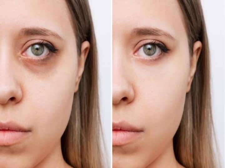 beauty tips dark circles removal remedies in hindi अब मेकअप से डार्क सर्कल छुपाने की नहीं पड़ेगी जरूरत, बस आज़माएं ये घरेलू नुस्खे, कुछ ही दिन में हो जाएगी काले घेरों की छुट्टी