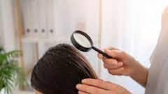 Dandruff : চটচটে খুশকির মতো দেখতে কিন্তু সাধারণ খুশকি নয় ! জেনে নিন চিকিৎসকরা কী বলছেন !