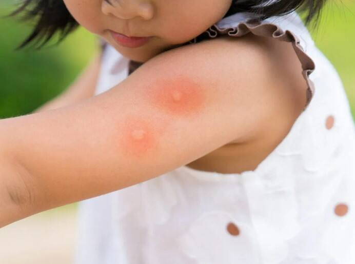 Dengue in Children : मान्सूनमध्ये डेंग्यूचा धोका अधिक वाढतो. ज्यात लहान मुलांचाही समावेश आहे.