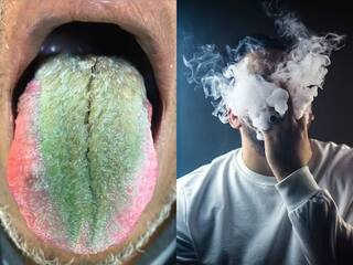 Shocking news: ਐਂਟੀਬਾਇਓਟਿਕਸ ਲੈਣ ਨਾਲ ਹਰੀ ਹੋ ਗਈ ਜੀਭ, ਆ ਗਏ ਕਾਲੇ ਵਾਲ, ਡਾਕਟਰ ਵੀ ਦੇਖ ਰਹਿ ਗਏ ਹੈਰਾਨ