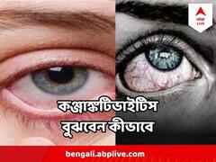 Conjunctivitis : চোখ রাঙাচ্ছে কঞ্জাঙ্কটিভাইটিস, হু হু করে সংক্রমণ, কী উপসর্গ? সারবে কীভাবে?