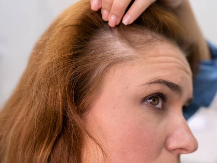 मानसून के मौसम में कई लोग बाल झड़ने की समस्या का सामना करते हैं. क्योंकि हवा में मौजूद नमी स्कैल्प को ऑयली बना देती है, जिसकी वजह से आपको बालों में चिपचिपापन महसूस होता है.